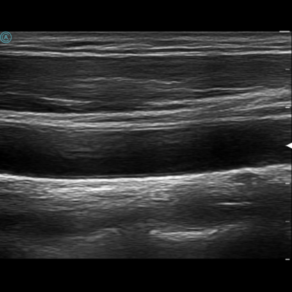 The neo L154 wireless handheld ultrasound imaging the carotid.