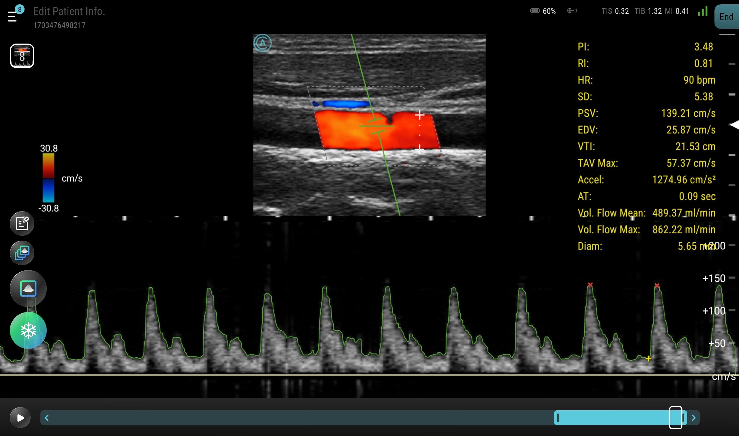 The neo L154 wireless handheld ultrasound viewing the Carotid with PW, using the AutoTrace feature to calculate.