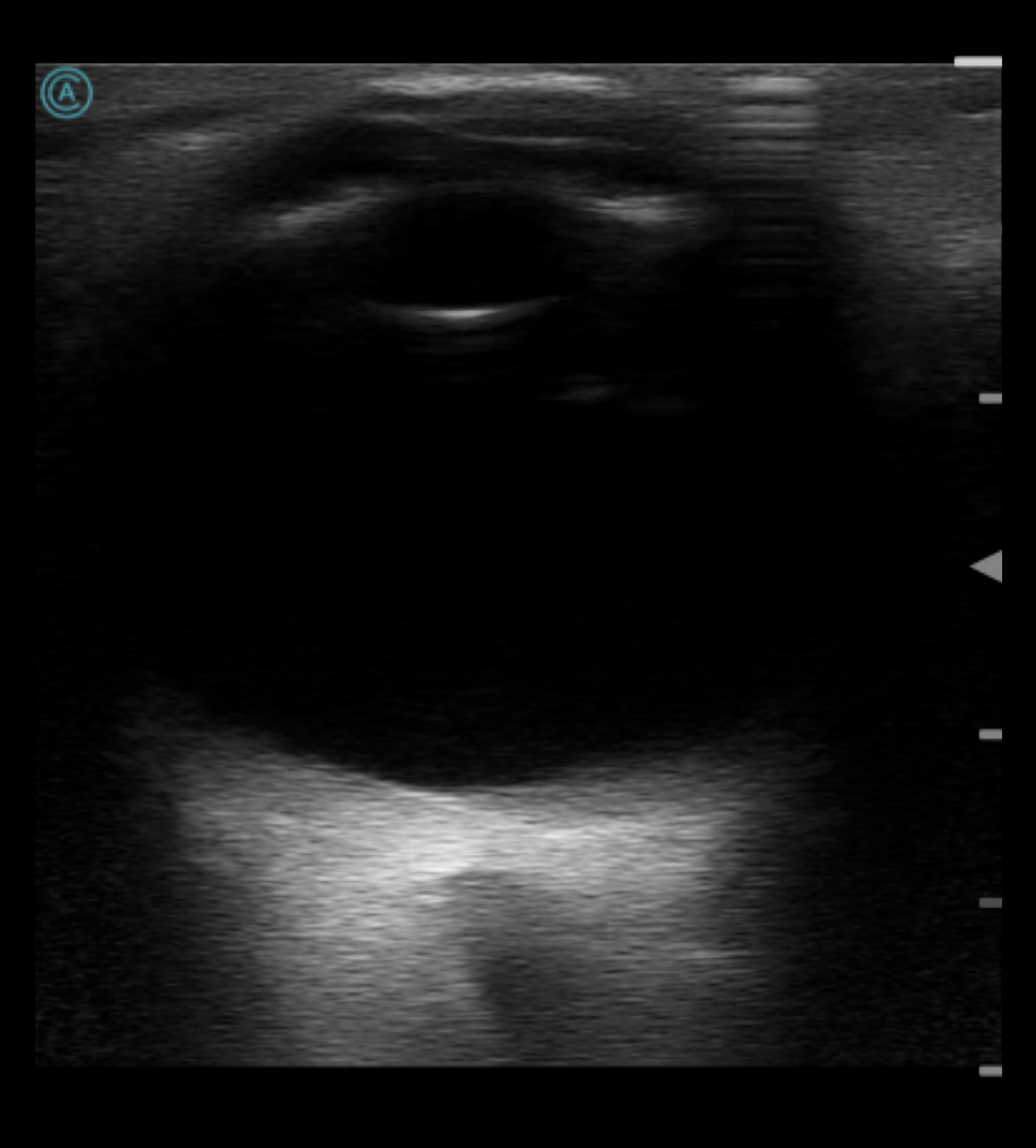 Focused ocular exam using the neo L187 Wireless Handheld Ultrasound System