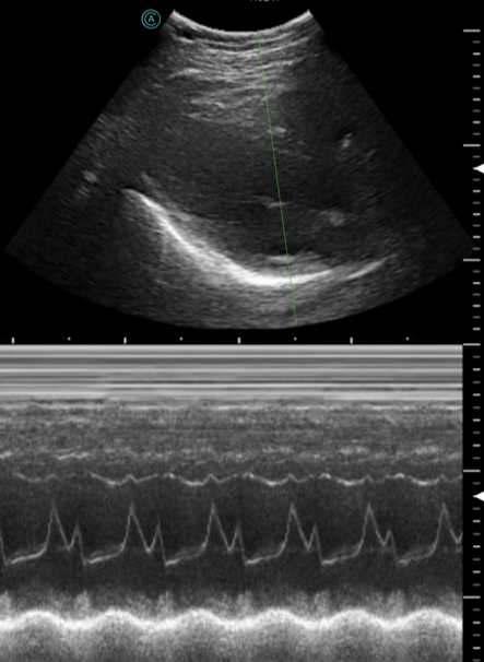 Viewing the heart using M Mode on the neo C62 wireless handheld ultrasound