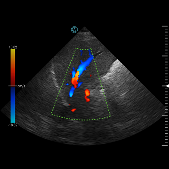 Viewing the liver with color doppler using the neo P42 Wireless Handheld Ultrasound System