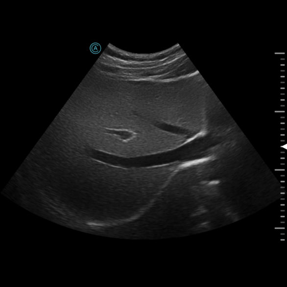 A frozen image of the liver using the neo C62 wireless handheld ultrasound