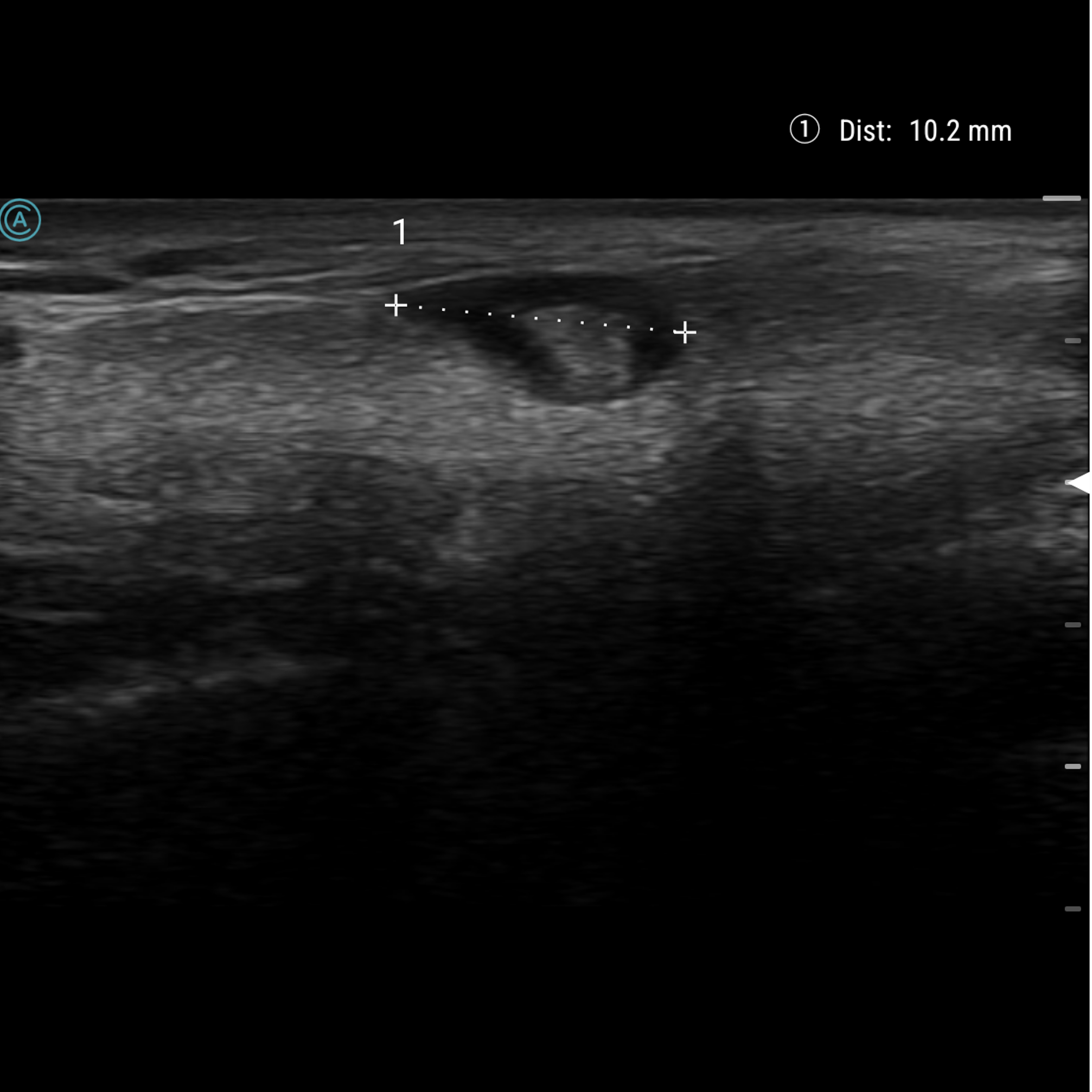 Imaging and measuring lymph nodes using the neo L154 wireless handheld ultrasound