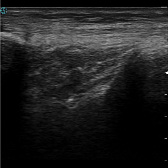 Imaging the patellar tendon with the neo L154 wireless handheld ultrasound