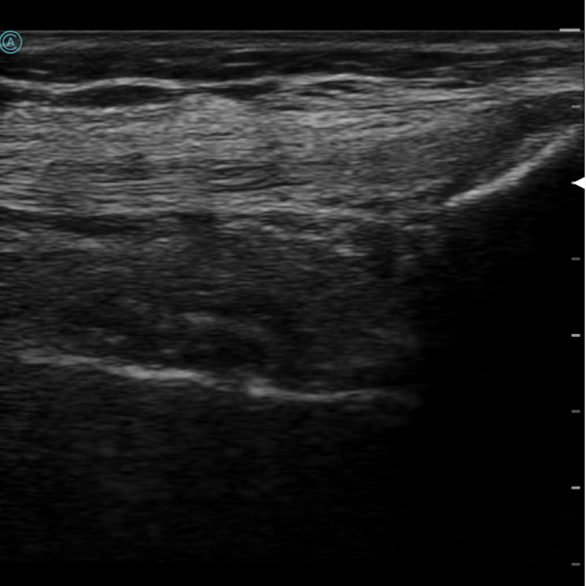 Viewing the quadriceps tendon with the neo L154 wireless handheld ultrasound