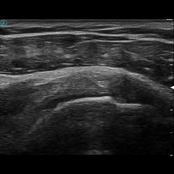 neo L154 Wireless Handheld Ultrasound viewing the supraspinatus