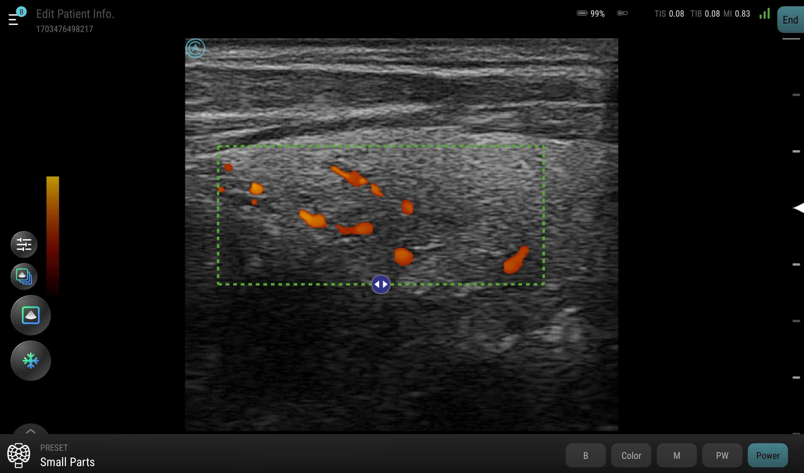Another view of the thyroid using the Power mode feature of the neo L154 Wireless Handheld Ultrasound