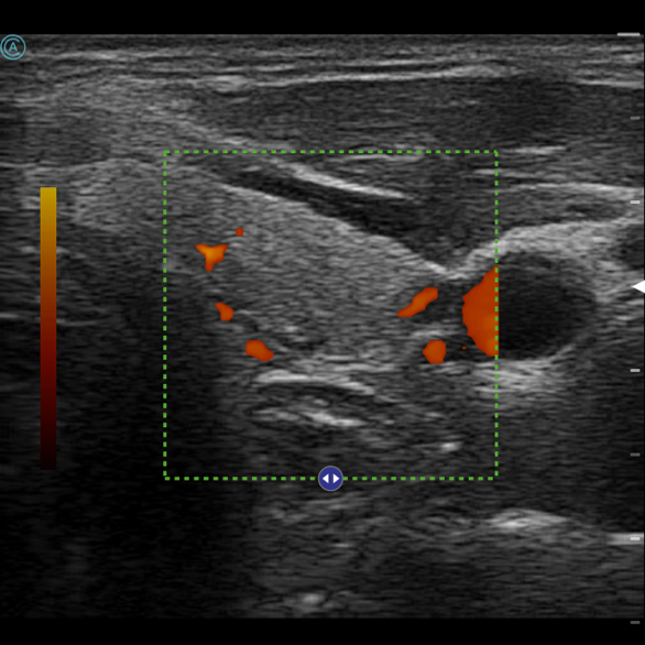Viewing the thyroid in Power mode using the neo L154 Wireless Handheld Ultrasound