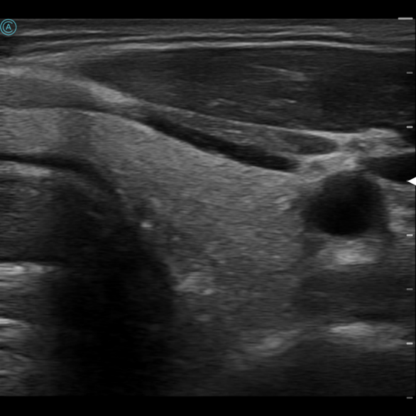 Viewing the Thyroid without color using the neo L154 Wireless Handheld Ultrasound