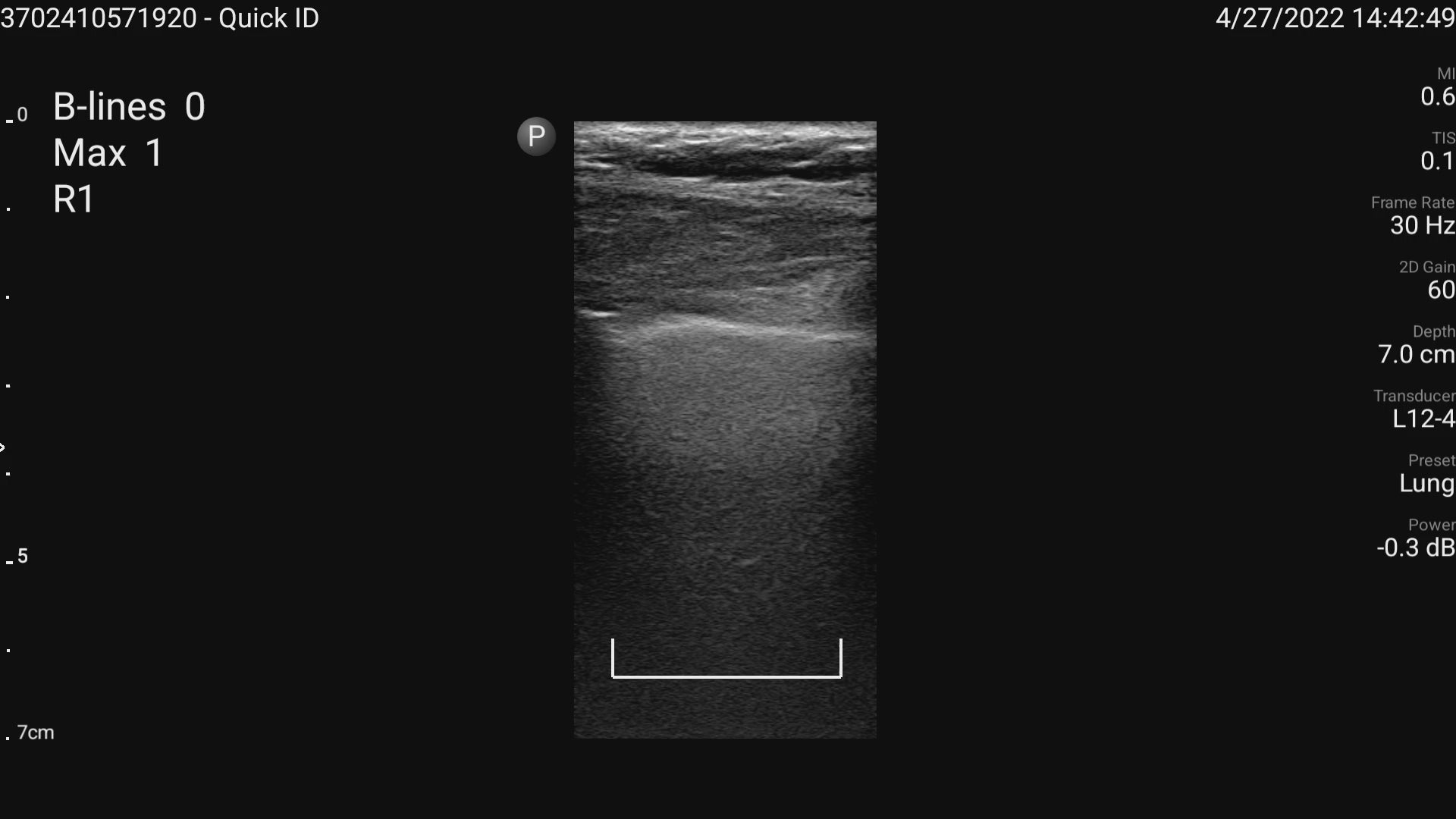 AI enchanced B-lines seen on the Lumify handheld Ultrasound machine