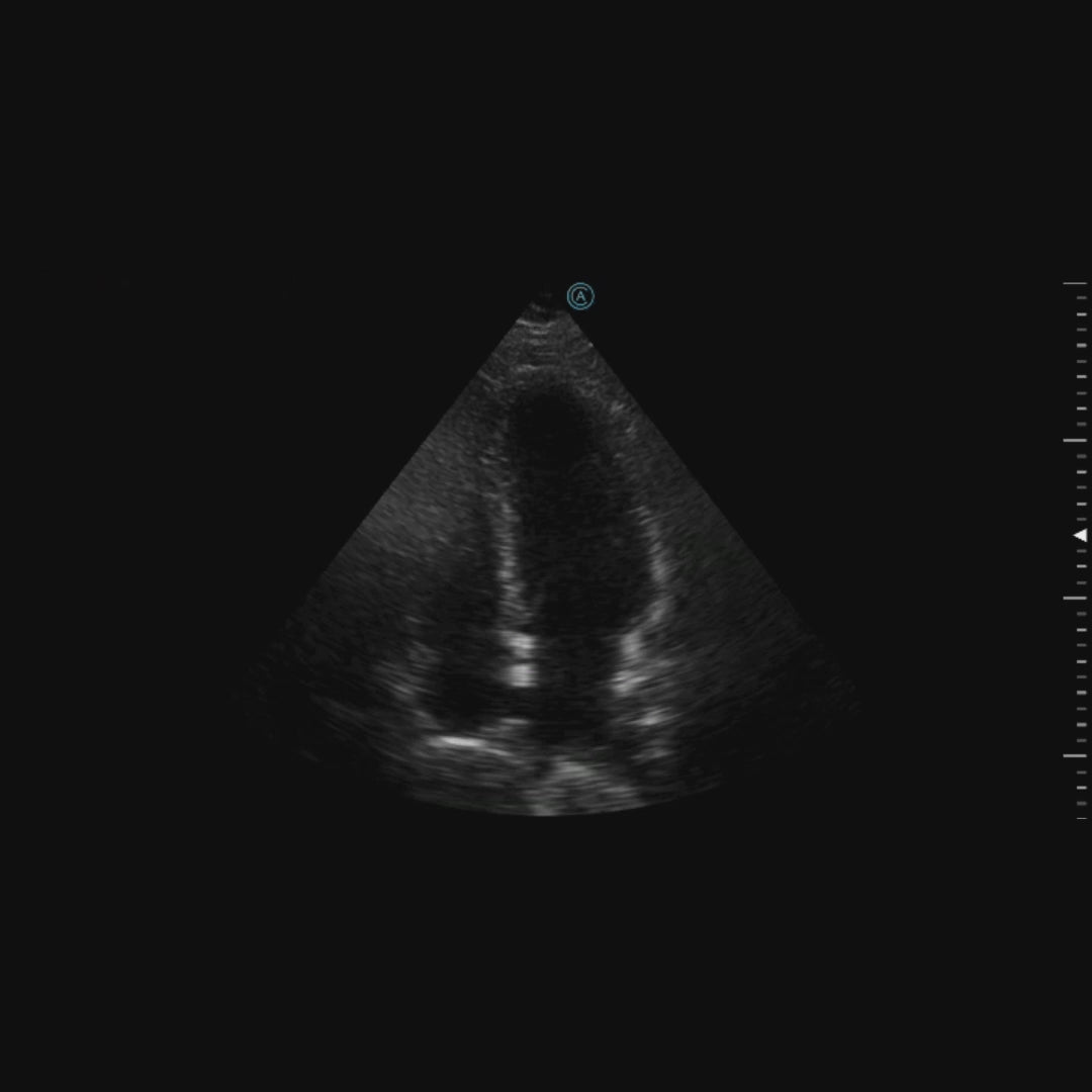 Apical four chamber (A4C) loop using the neo P42 Wireless Handheld Ultrasound System