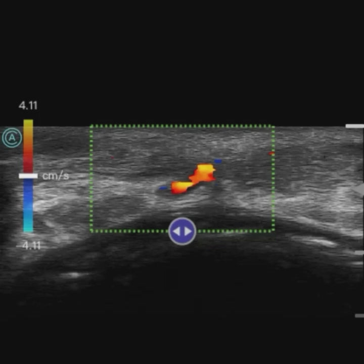 Using the neo L187 Wireless Handheld Ultrasound System to map vasculature in the lips.