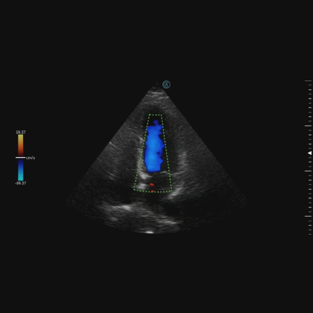 A4C (apical four chamber) view with color doppler