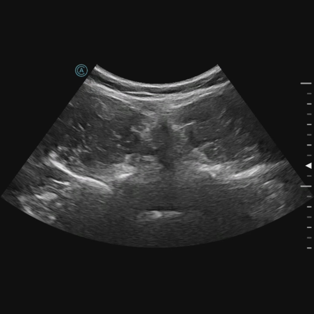 cineloop of the lumbar in transverse using the neo C62 wireless handheld ultrasound