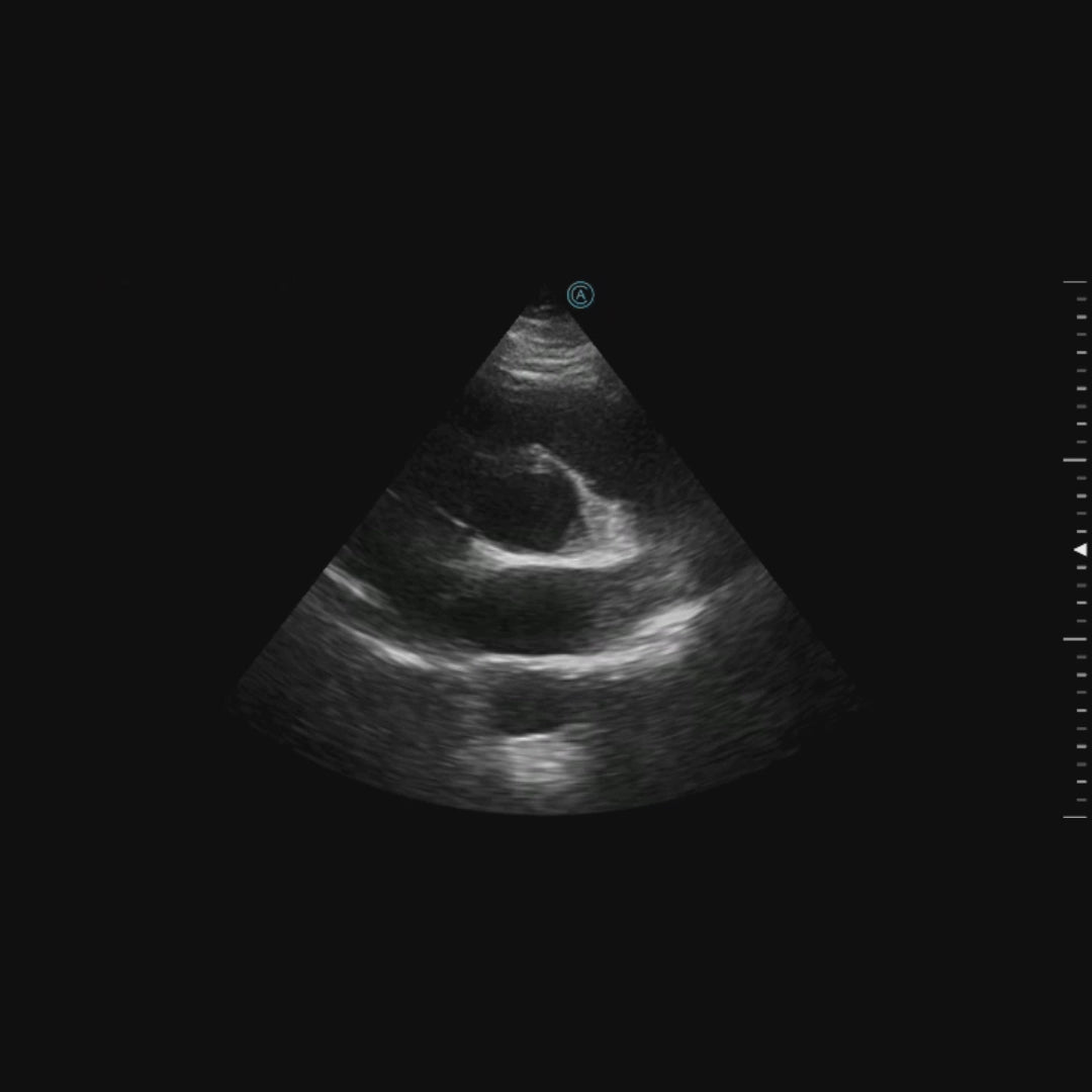 PSAX view of of the heart using the neo P42 Wireless Handheld Ultrasound System