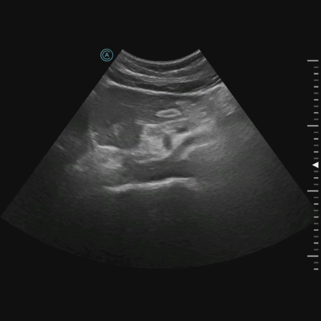 Evaluating the Aorta during a routine exam.