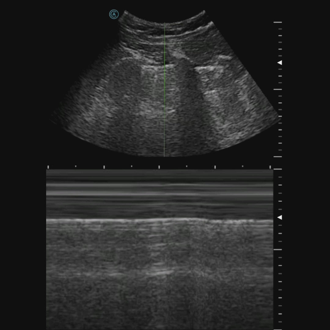 Using the neo C62 to visualize the lung tissue using M Mode