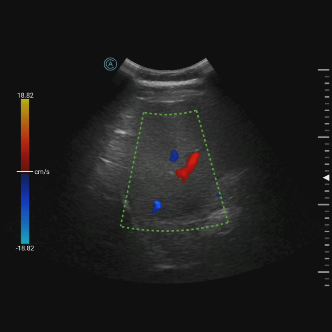 Viewing the liver with color flow using the neo C62 wireless handheld ultrasound