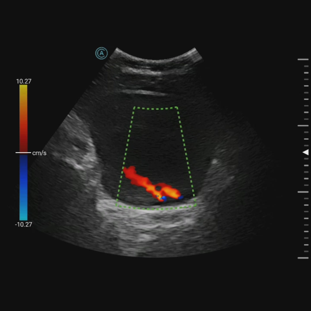 The neo C62 color doppler reveals ureter ejection