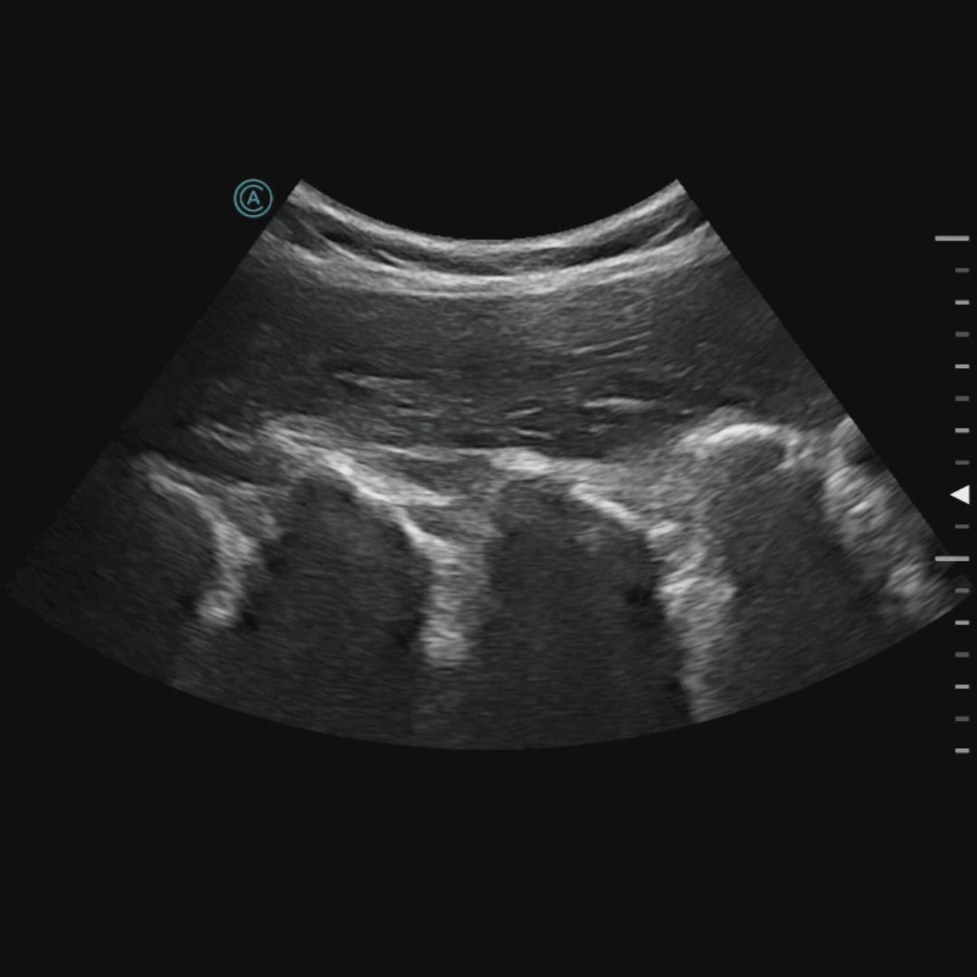cineloop of the lumbar in sagittal view using the neo C62 wireless handheld ultrasound