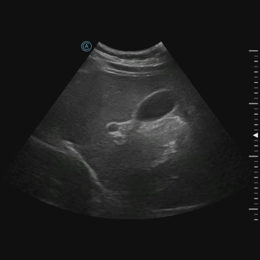 visualization of the Gallbladder using the neo C62 wireless handheld ultrasound transducer