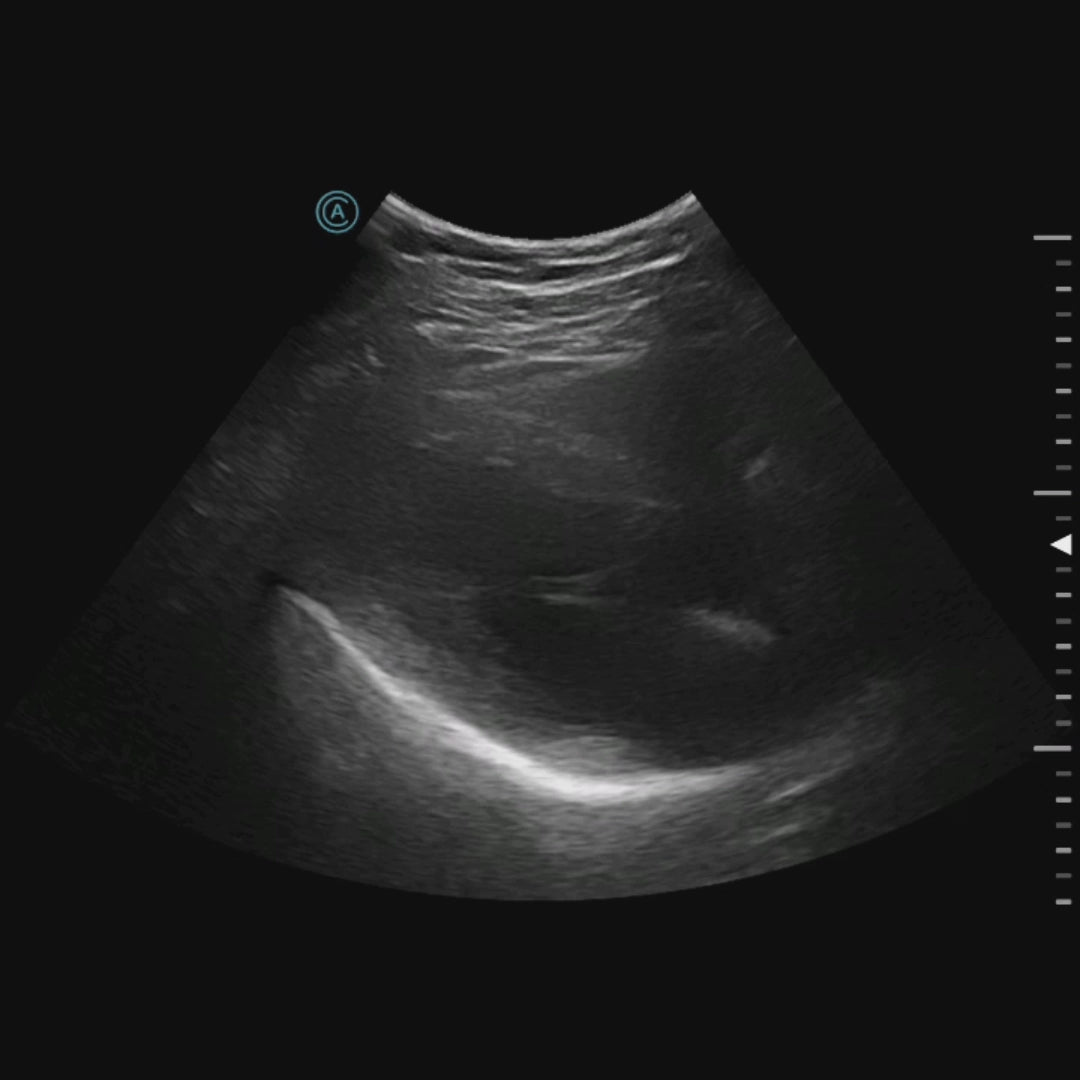 The neo C62 viewing the heart through the parasternal long axis window.