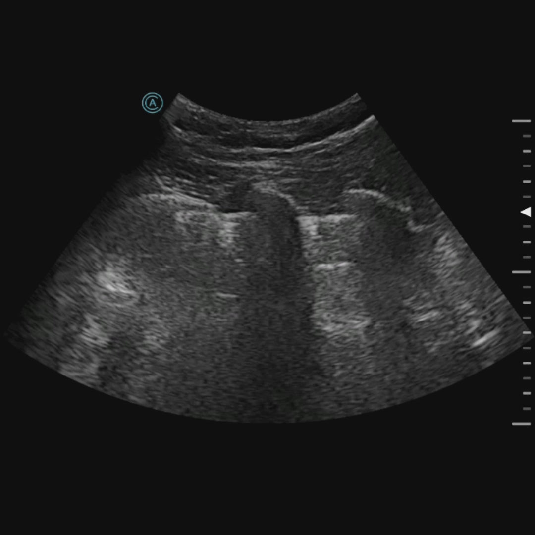 lung imaging using the neo C62 wireless handheld ultrasound
