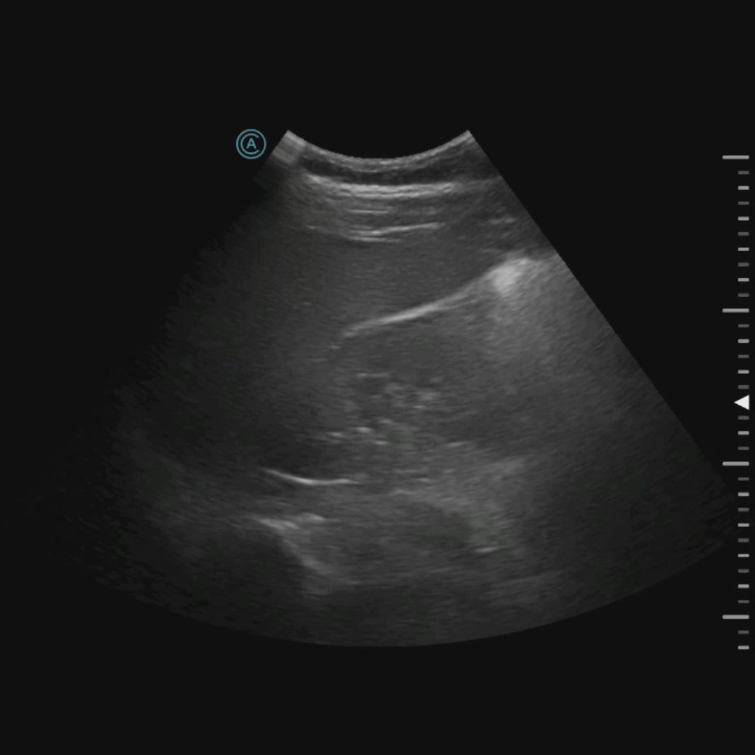 Using the neo C62 to pan across the liver in a quick focused exam