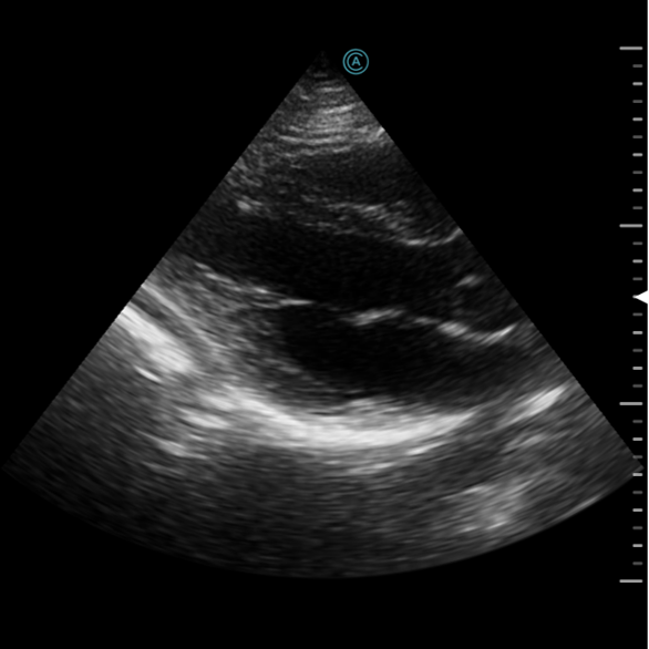 PLAX (parasternal long axis) view of the heart using the neo P42 Wireless Handheld Ultrasound System