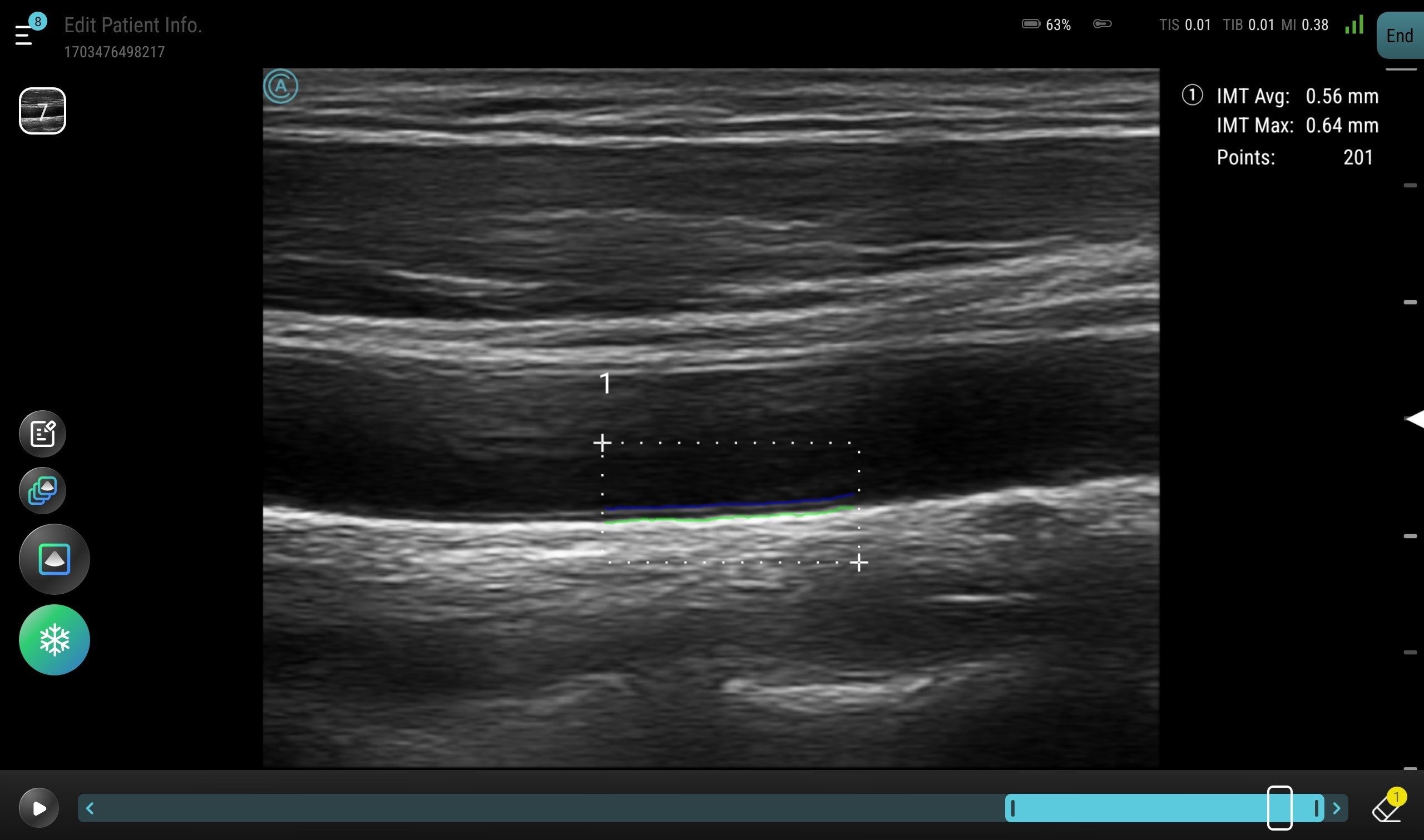 Leveraging AI to measure the IMT of the carotid using the neo L187 Wireless Handheld Ultrasound System