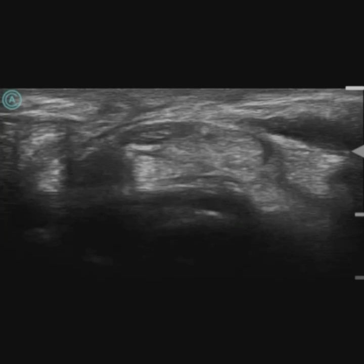 Visualization of the median nerve using the neo L187 Wireless Handheld Ultrasound System