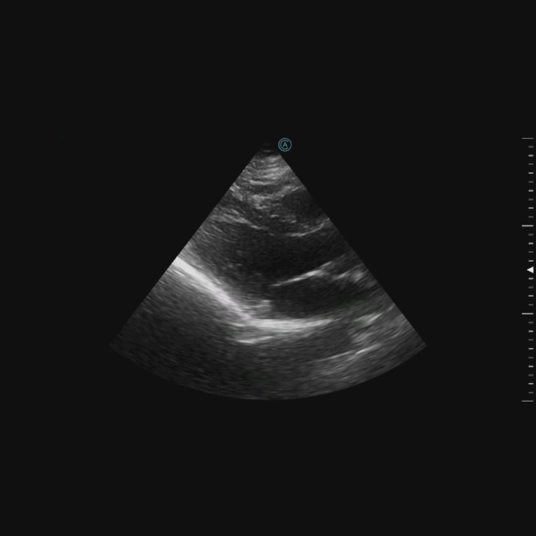 PLAX loop using the neo P42 Wireless Handheld Ultrasound System