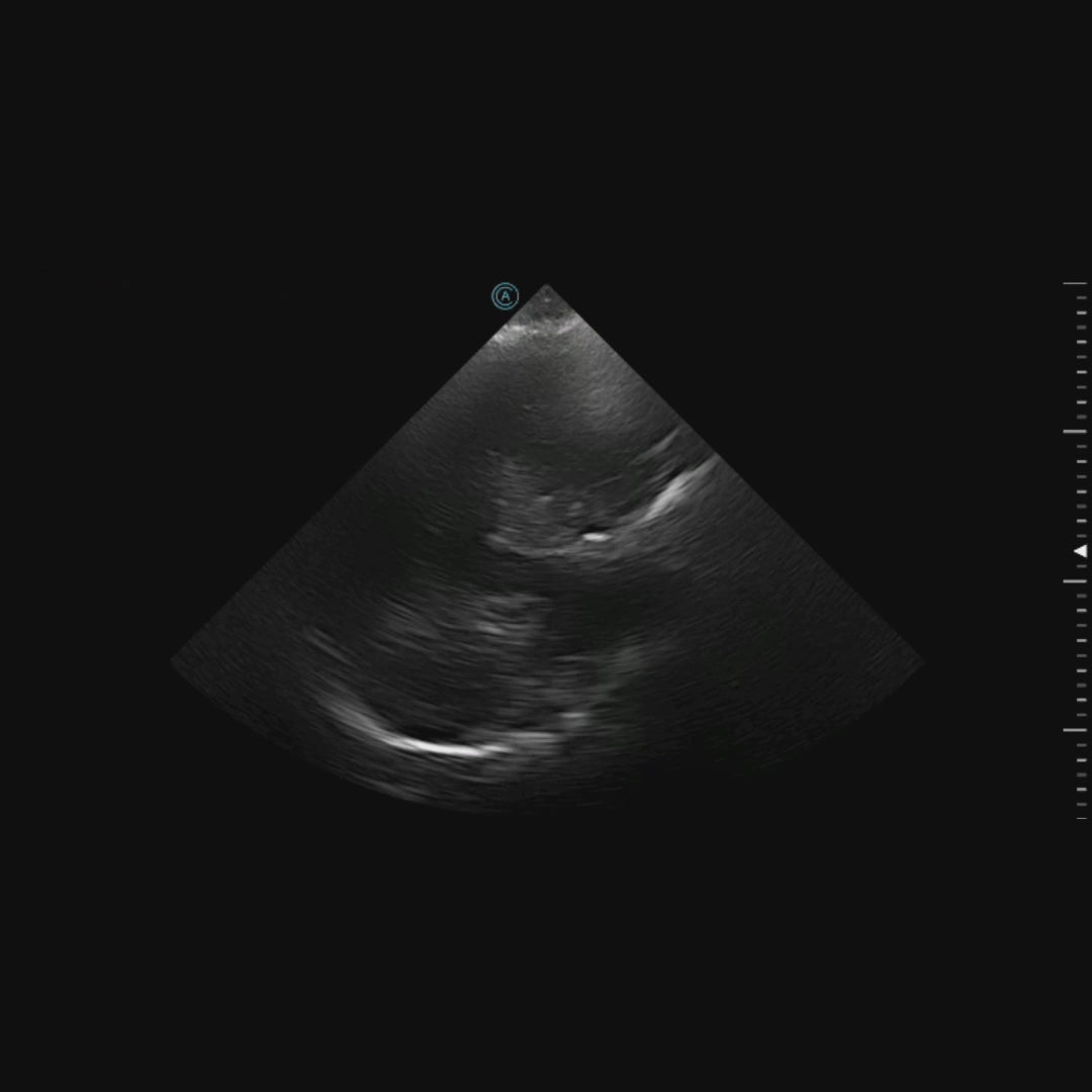 Transcranial imaging using the neo P42 Wireless Handheld Ultrasound System