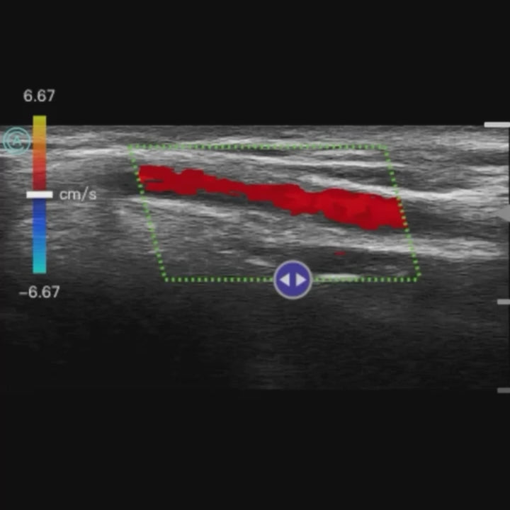 Viewing the radial artery with color using  the neo L187 Wireless Handheld Ultrasound System