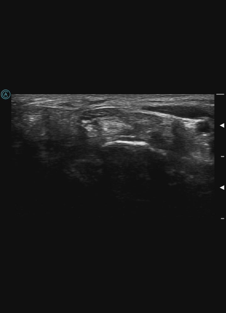 Live loop of the median nerve using the neo L187 Wireless Handheld Ultrasound System